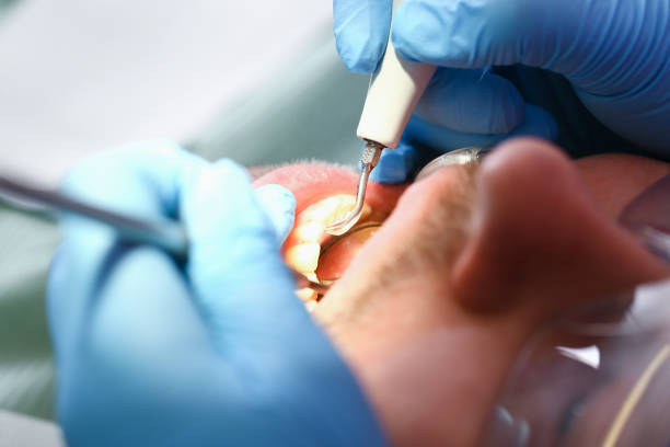 Best Emergency Gum Treatment in Ocean City, FL